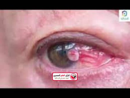 جراحه العيون :الاستخدام المفرط للهواتف المحمولة يؤثر على العيون بشكل سلبي 1